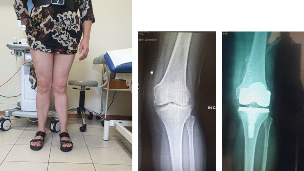 protesi-ginocchio-4
