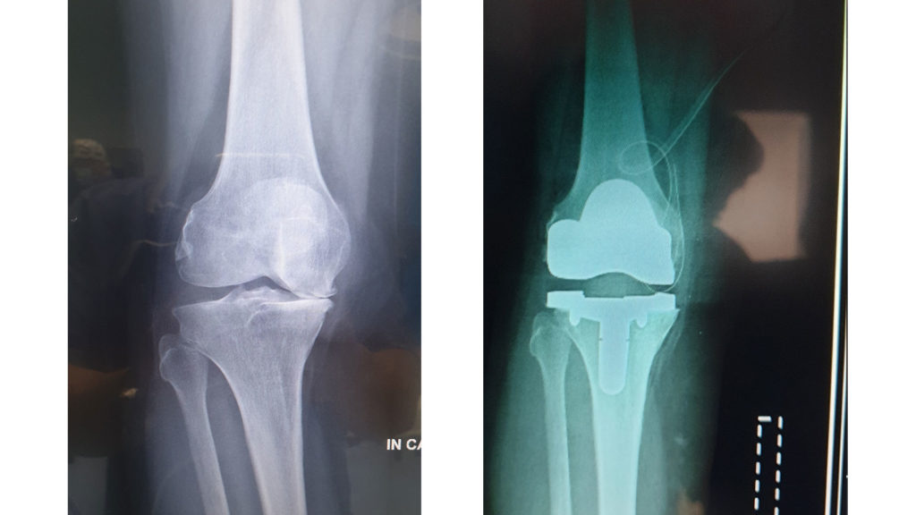 protesi-ginocchio-6