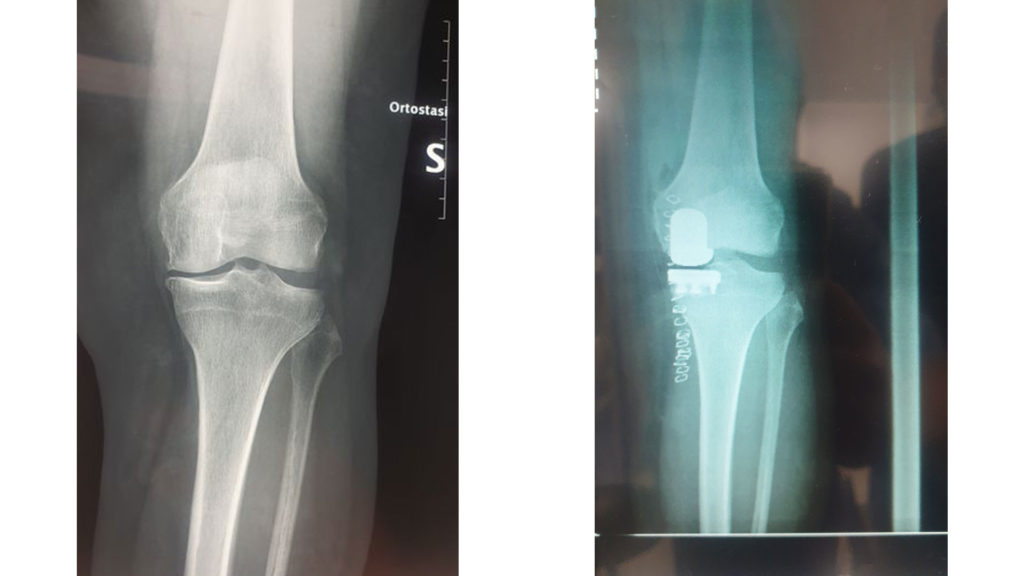 protesi-parziale-ginocchio